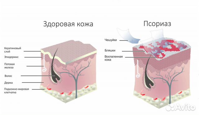 Доброволец в медицинских испытаниях по псориазу