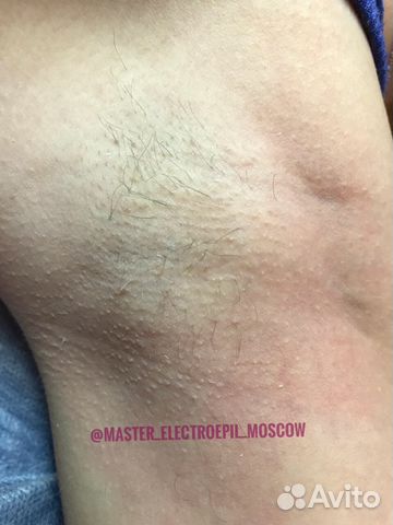 Электроэпиляция Жен/Муж Электроэпиляция Жен/Муж