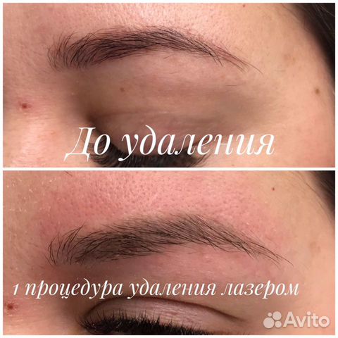 Удаление татуажа, перманентного макияжа, татуирово