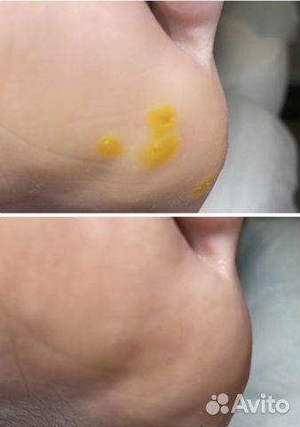 Удаление бородавок